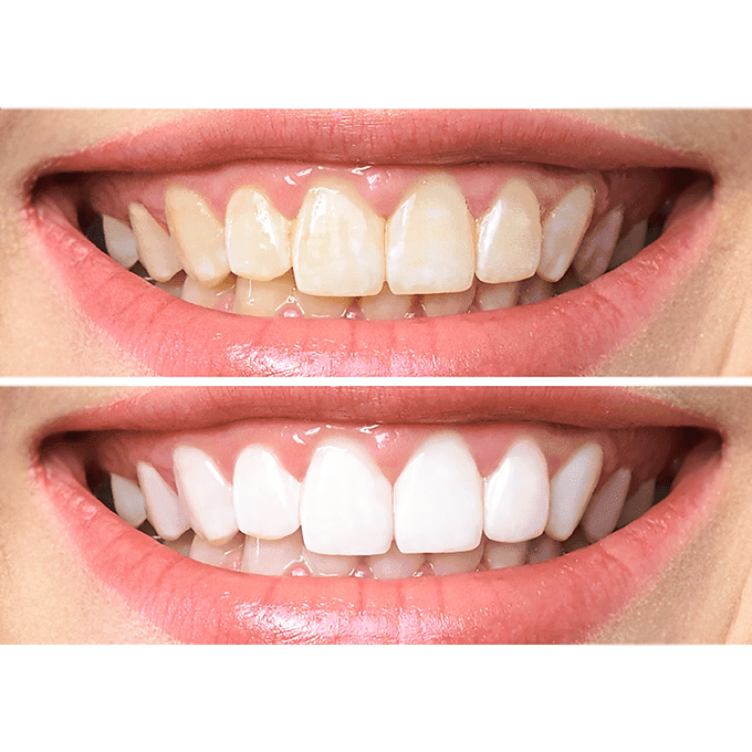 ستيللا وايت - 6 لصقات لتبييض الأسنان